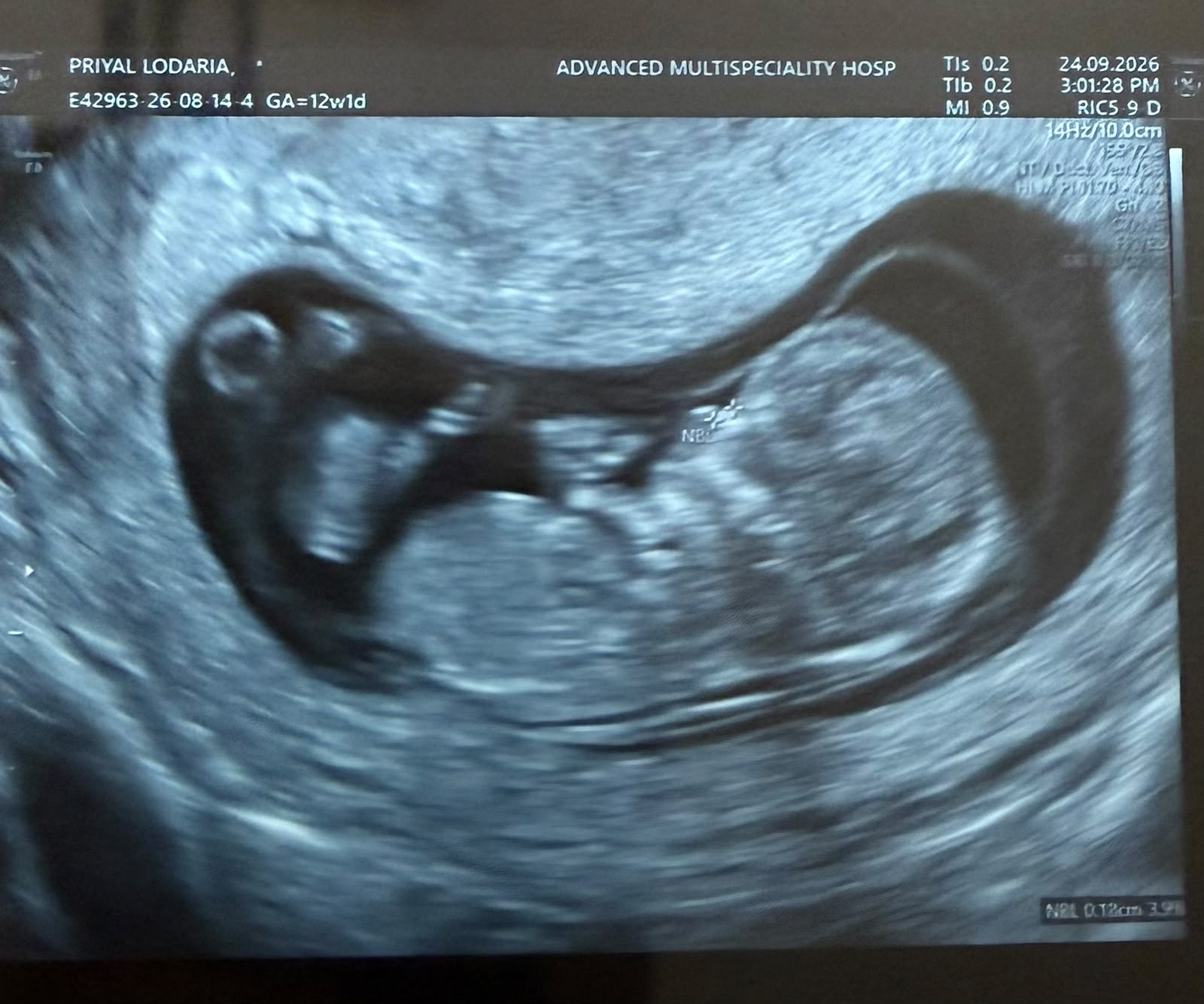 Baby J’s ultrasound